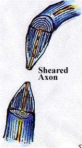 Sheared Axon — Omaha, NE — Law Office of Stephen L. Gerdes