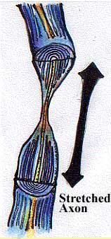 Stretched Axon — Omaha, NE — Law Office of Stephen L. Gerdes