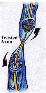 Twisted Axon — Omaha, NE — Law Office of Stephen L. Gerdes