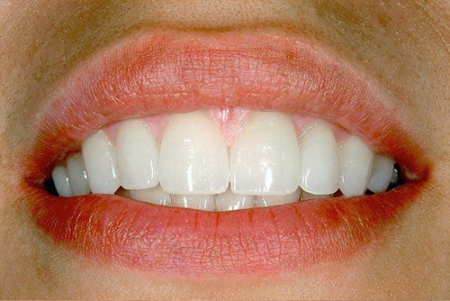 Veneers After