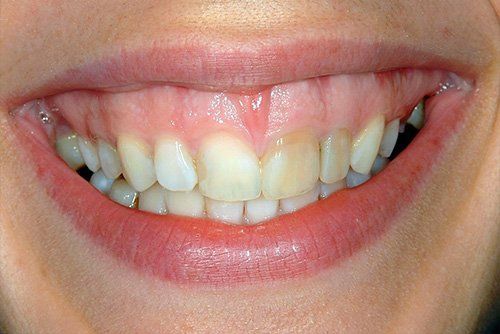 Veneers Before
