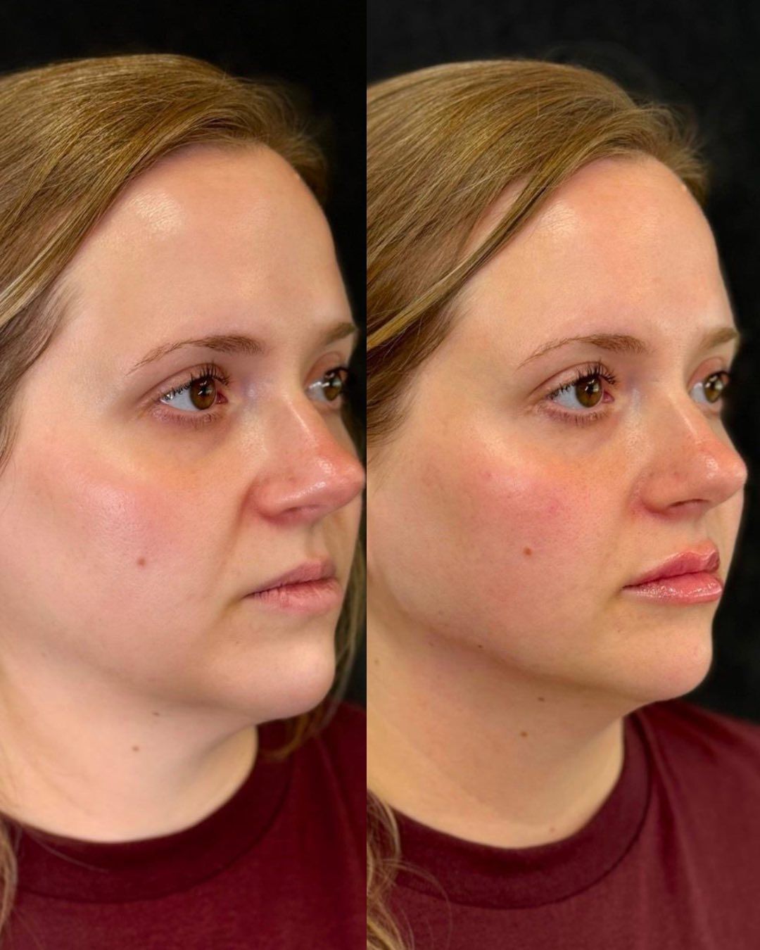 Two side-profile views of a person’s face; before and after apparent cosmetic procedure. Features enhanced, skin flushed.
