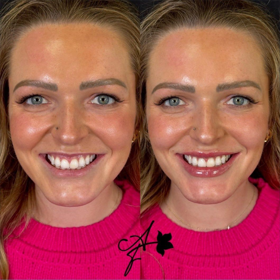 Side-by-side comparison of a person's face. Left: before. Right: after lip augmentation, smiling.