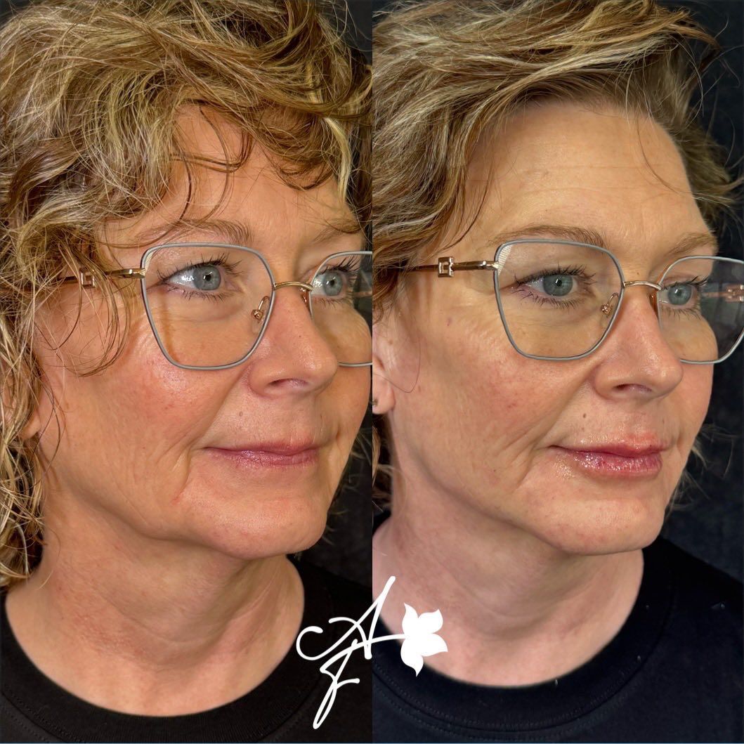Side-by-side comparison of a person's face. Left side shows wrinkles, right side is smoother. They wear glasses.