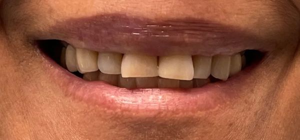 Close-up of a smiling mouth with visible teeth. The teeth vary in color, lips are dark.