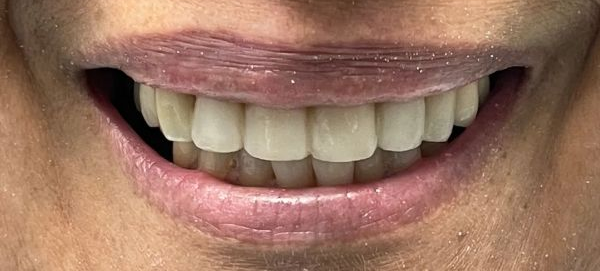 a close up of a woman 's smile with white teeth | Dental Crowns | Restoration and Smile makeover | Before and After Dental Treatment | Barclay Family Dental | Best Dentist For Family Dentistry, Dental Implants, and Cosmetic Dentistry in Cherry Hill, NJ