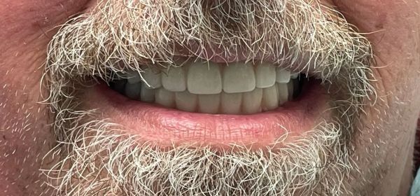 a close up of a man 's mouth with a beard | All on x | Full mouth restoration | Before and After Dental Treatment | Barclay Family Dental | Best Dentist For Family Dentistry, Dental Implants, and Cosmetic Dentistry in Cherry Hill, NJ