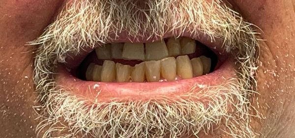 Close-up of a person's open mouth, showing yellowish teeth and a grey-white beard.