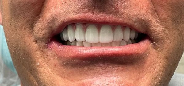 a close up of a man 's mouth with white teeth | All on X - Full Mouth Restoration | Before and After Dental Treatment | Barclay Family Dental | Best Dentist For Family Dentistry, Dental Implants, and Cosmetic Dentistry in Cherry Hill, NJ