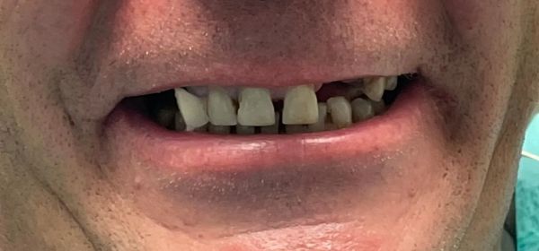 Close-up of a person's mouth, showing visible teeth, some missing, slightly open, with a hint of a smile.