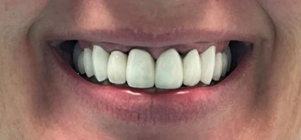 Close-up of a person smiling, showing a set of straight, bright white teeth.