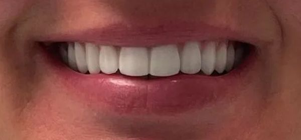 a close up of a woman 's smile with white teeth | All on x | Full arch dental implants of upper teeth only | Full mouth restoration | Smile Makeover | Before and After Dental Treatment | Barclay Family Dental | Best Dentist For Family Dentistry, Dental Implants, and Cosmetic Dentistry in Cherry Hill, NJ