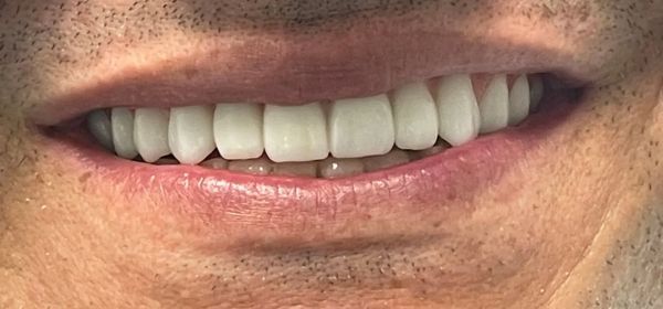 a close up of a man 's mouth with white teeth | all on x | Upper only, full arch dentistry | Before and After Dental Treatment | Barclay Family Dental | Best Dentist For Family Dentistry, Dental Implants, and Cosmetic Dentistry in Cherry Hill, NJ