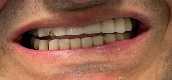 Close-up of a person's teeth. The upper teeth are white and aligned. Lower teeth are more yellowed. The lips are visible.