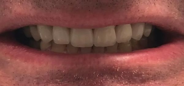 Full mouth restoration | Smile Makeover | Before and After Dental Treatment | Barclay Family Dental | Best Dentist For Family Dentistry, Dental Implants, and Cosmetic Dentistry in Cherry Hill, NJ