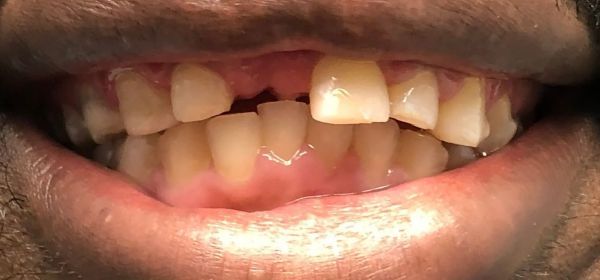 Close-up of a person's mouth with crooked teeth. Some teeth are missing.