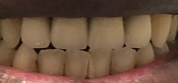 a close up of a person 's mouth showing their teeth | Anterior Crowns | Front Crowns | Full mouth restoration | Smile Makeover | Before and After Dental Treatment | Barclay Family Dental | Best Dentist For Family Dentistry, Dental Implants, and Cosmetic Dentistry in Cherry Hill, NJ