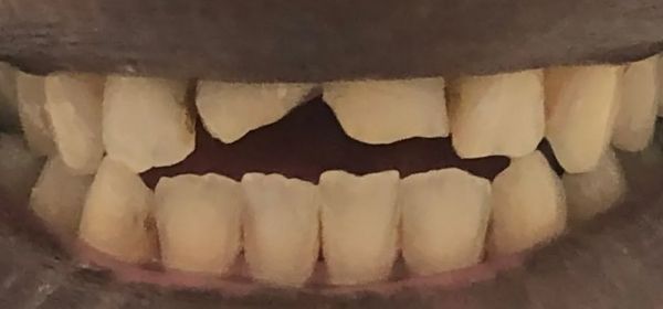 Close-up of a person's mouth with visible teeth. Several front teeth are chipped. The skin is dark.