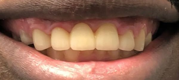 a close up of a man 's teeth with a beard | Anterior bridge | Front Tooth Replacement | Full mouth restoration | Smile Makeover | Before and After Dental Treatment | Barclay Family Dental | Best Dentist For Family Dentistry, Dental Implants, and Cosmetic Dentistry in Cherry Hill, NJ