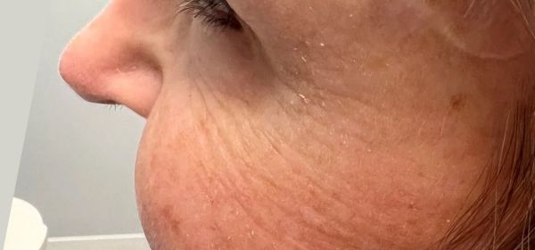 a close up of a woman 's face with wrinkles | Botox Treatment | Cosmetic D