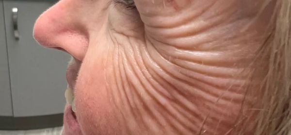 Profile view of a person with deep wrinkles on their face; in a medical setting.