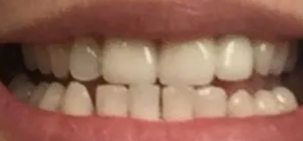 a close up of a woman 's mouth with white teeth and red lips | Dental Crowns and Dental Bridge | Full mouth restoration | Before and After Dental Treatment | Barclay Family Dental | Best Dentist For Family Dentistry, Dental Implants, and Cosmetic Dentistry in Cherry Hill, NJ