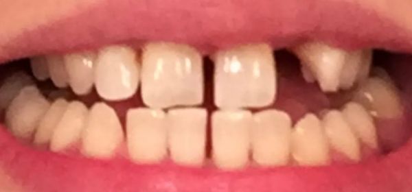 Close-up of a person's mouth, showing visible teeth with a noticeable gap and a missing tooth.