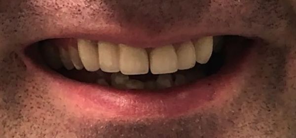 a close up of a man 's mouth with his teeth showing | Dental Crowns and Dental Bridge | Full mouth restoration | Smile Makeover | Before and After Dental Treatment | Barclay Family Dental | Best Dentist For Family Dentistry, Dental Implants, and Cosmetic Dentistry in Cherry Hill, NJ