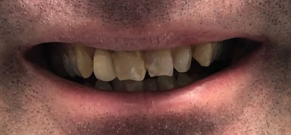 Close-up of a person's mouth showing yellowed and slightly chipped teeth; smiling.
