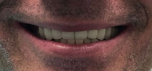 a close up of a man 's face with a smile on his face | Full mouth dental crowns | Full mouth restoration | Smile Makeover | Before and After Dental Treatment | Barclay Family Dental | Best Dentist For Family Dentistry, Dental Implants, and Cosmetic Dentistry in Cherry Hill, NJ