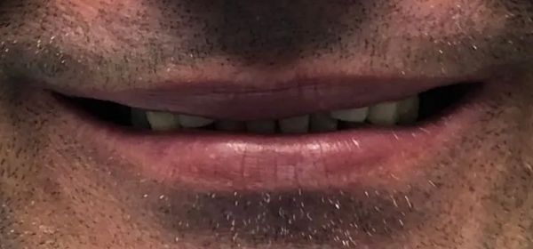 Close-up of a smiling person's mouth, showing upper and lower teeth, with a thin beard.