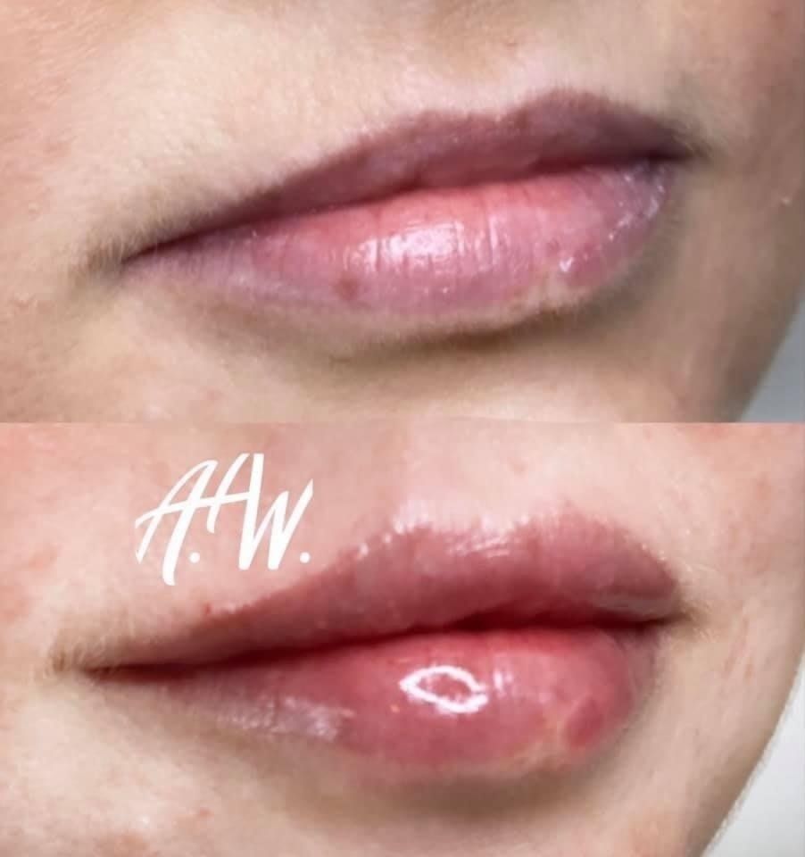 Lip fillers by la bella vita hair and beauty in Belfast