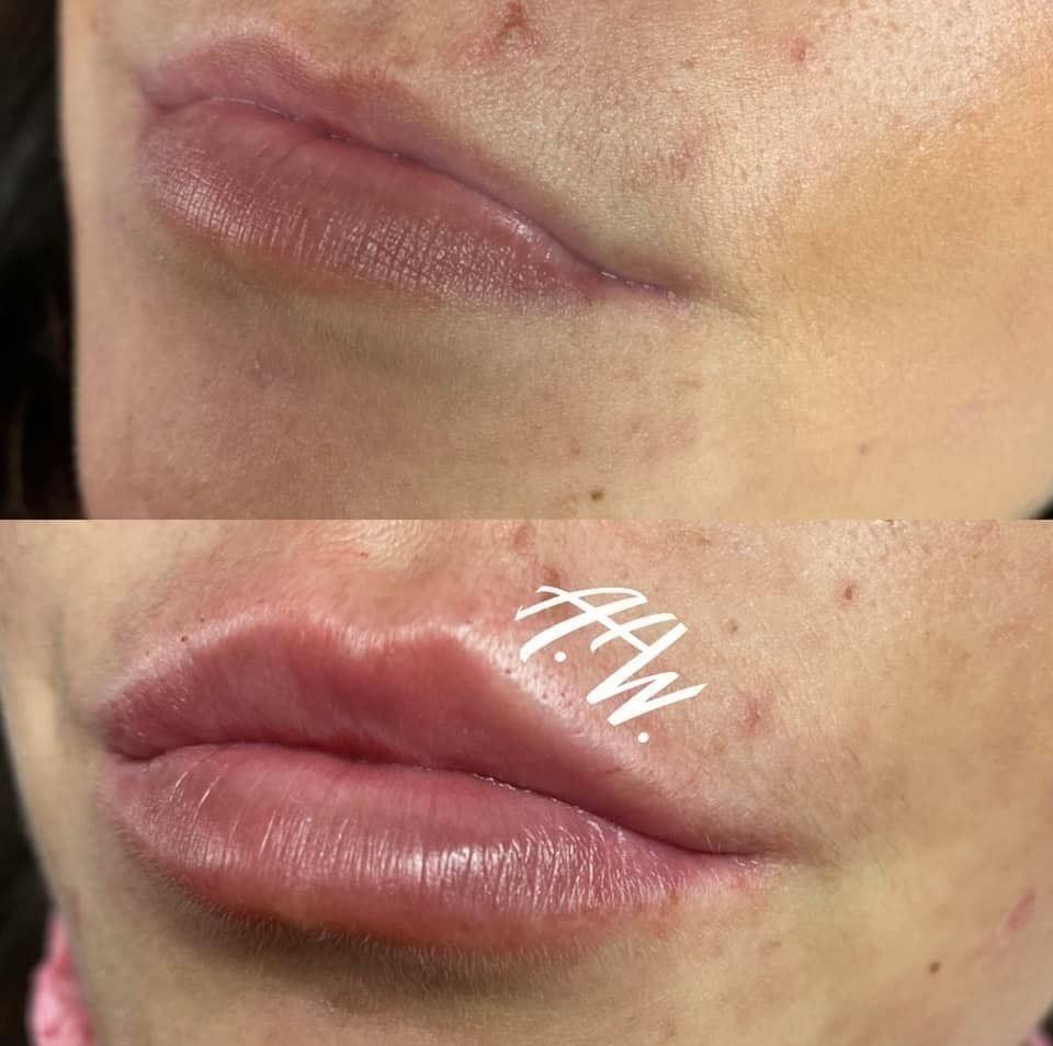 Lip fillers by la bella vita hair and beauty in Belfast
