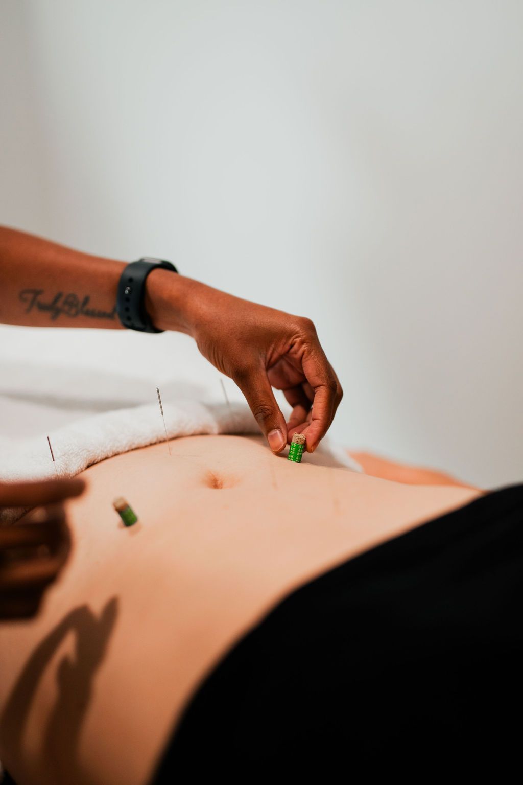 A woman is getting acupuncture and moxa on her stomach