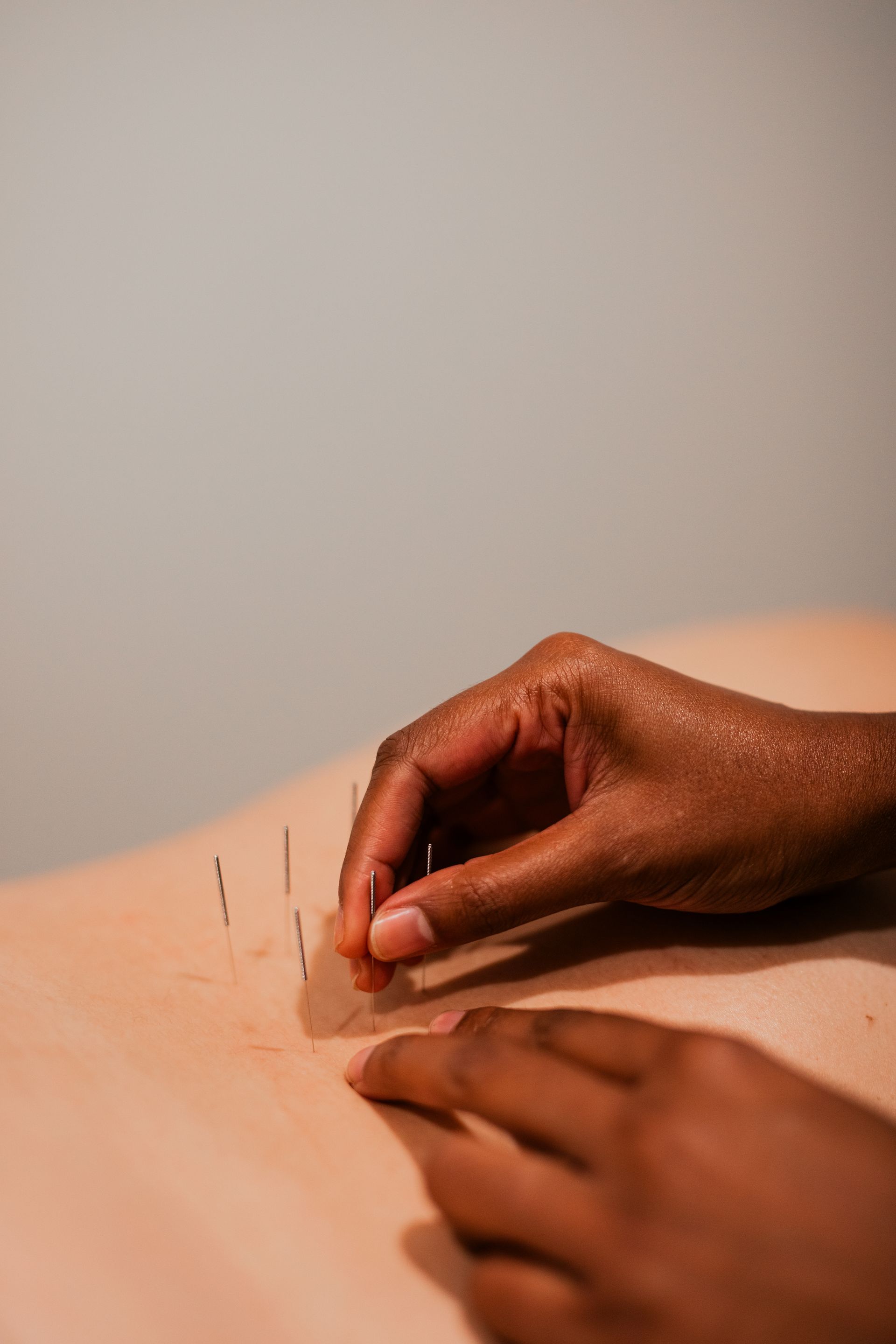 A person is getting acupuncture on their back.