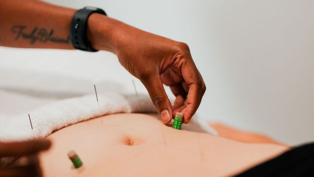 A person is getting acupuncture on their stomach.