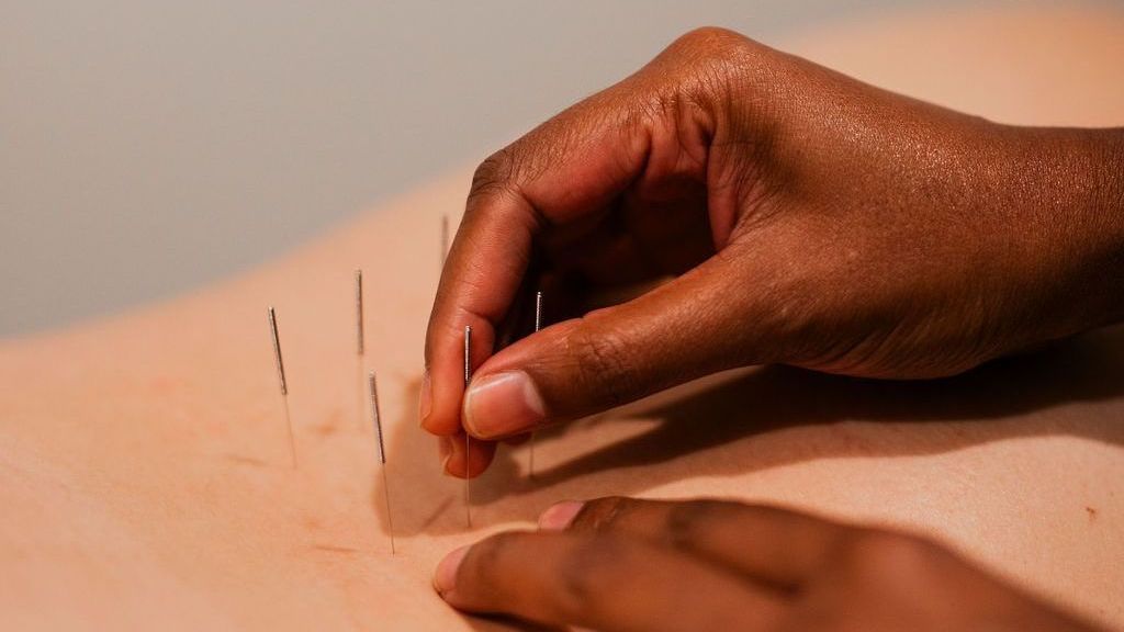 A person is getting acupuncture on their back.