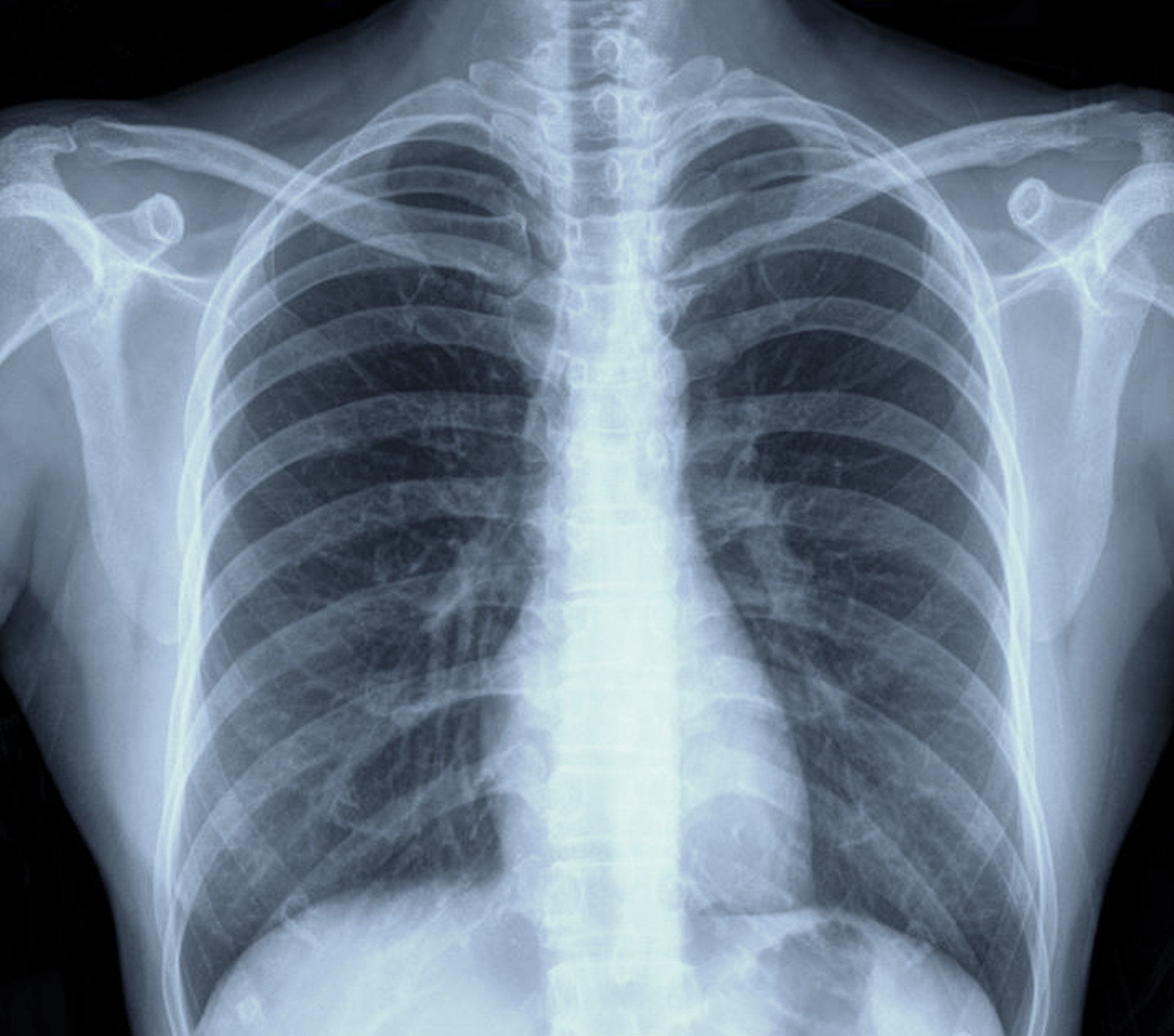 A close up of an x-ray of a person 's chest and ribs.