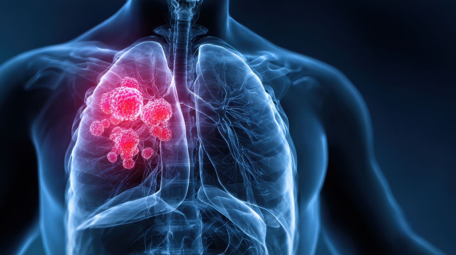 câncer de pulmão e poluição