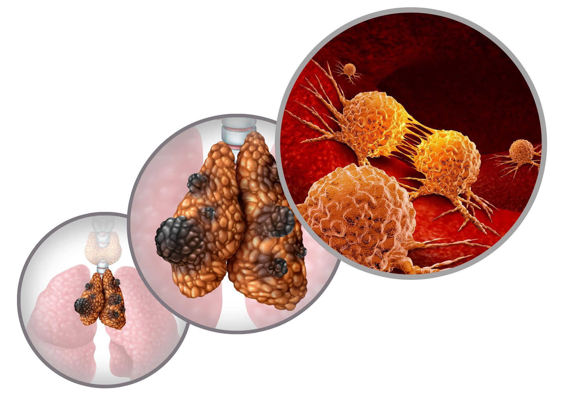 miastenia gravis e timoma