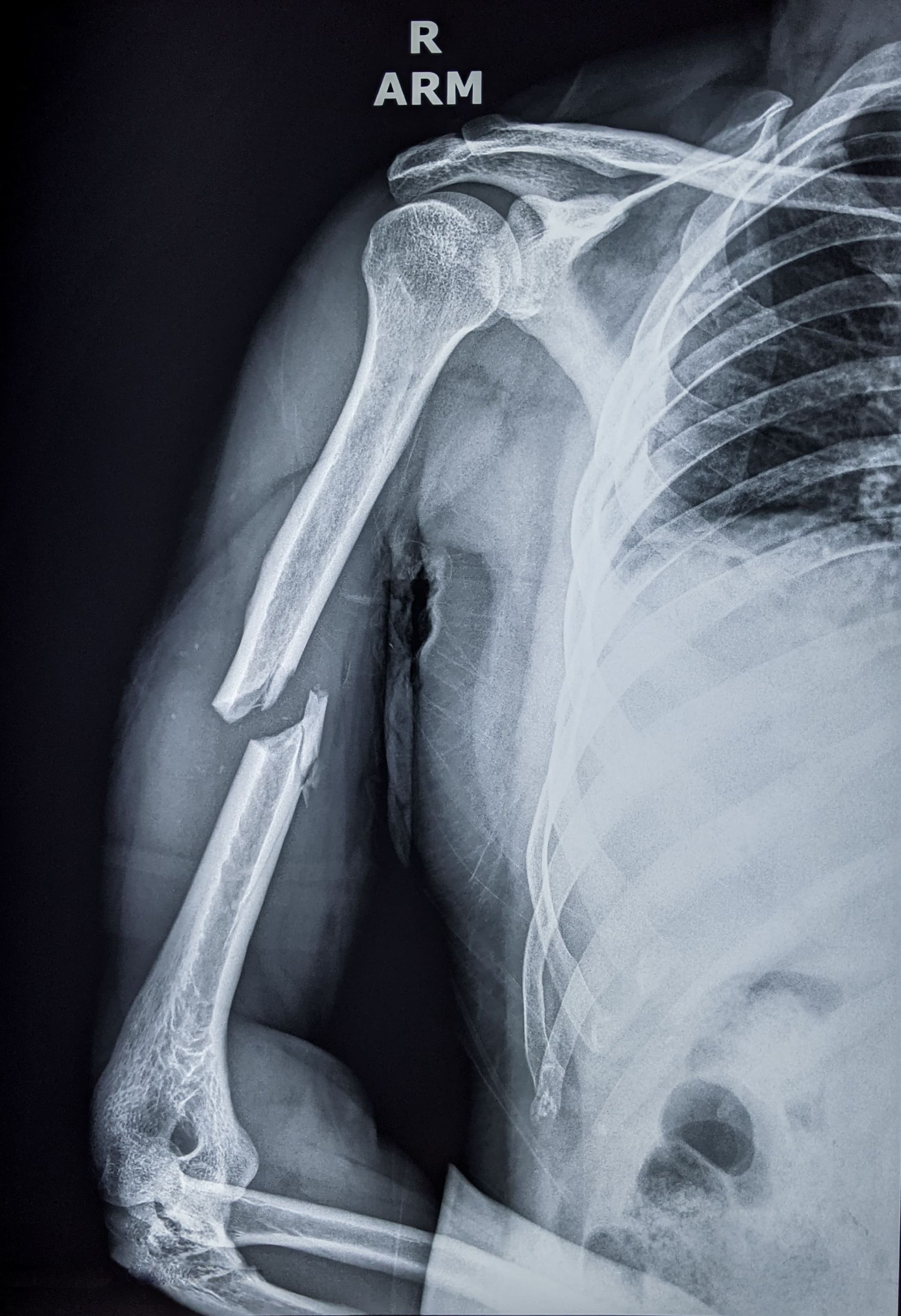 An x-ray of a person 's arm with a broken bone.