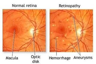 Treatment for Diabetic Eye Issues