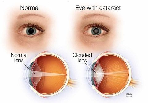 Cataract Signs and Symptoms