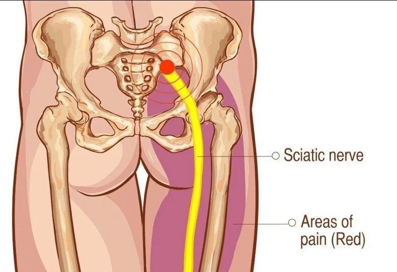Diagram of human pelvis and leg highlighting the sciatic nerve and areas of pain (red).