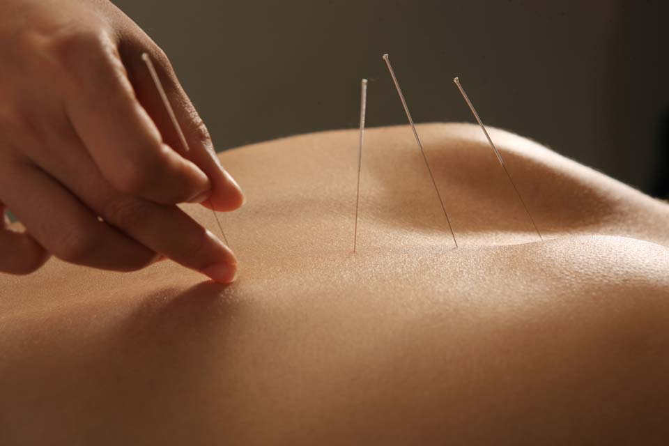Behandling av bjørkepollenallergi med akupunktur
