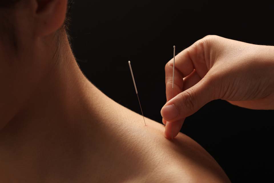 Behandling av gresspollenallergi med akupunktur