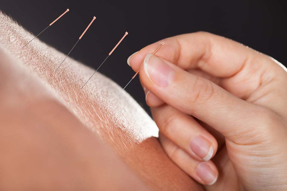 Behandling av allergi med akupunktur