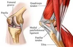 Patellofemoral-syndrom