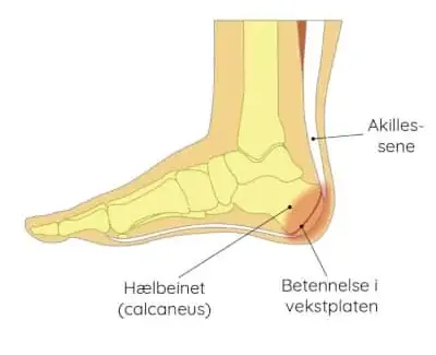 Severs sykdom