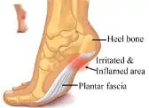 plantar fasciitt